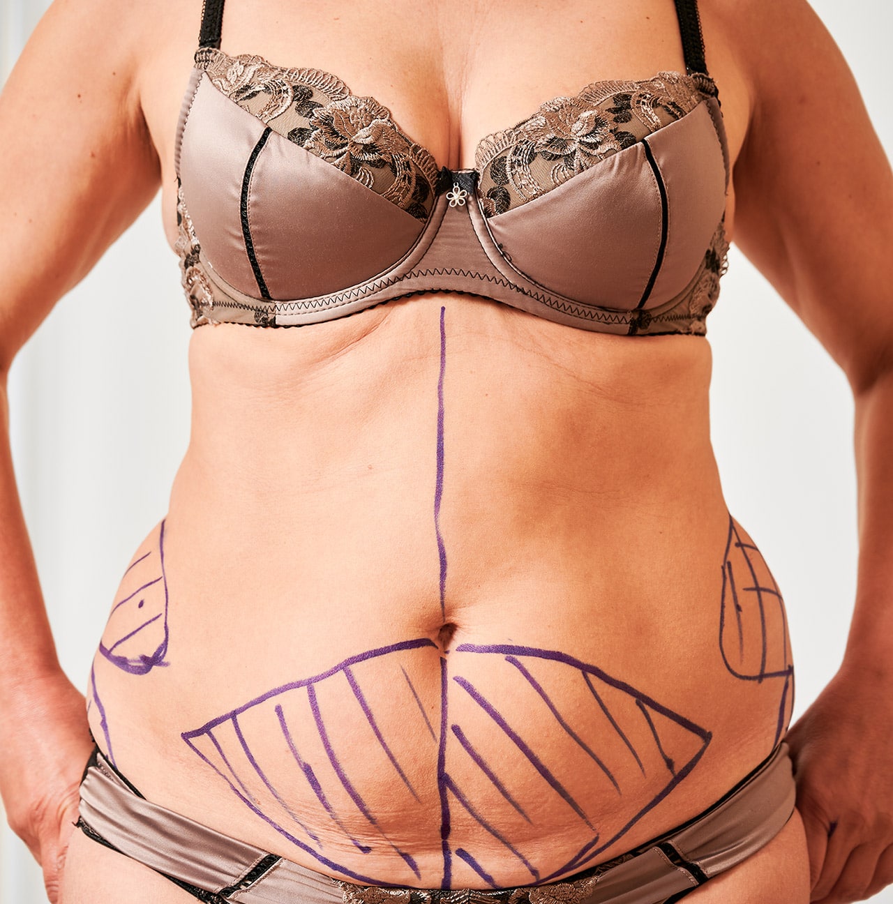 3d Laser Liposuction